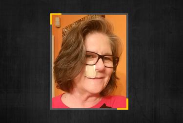 “This wasn’t an elective surgery,” says Susan Carson of Dallas, who has previously battled other forms of skin cancer.